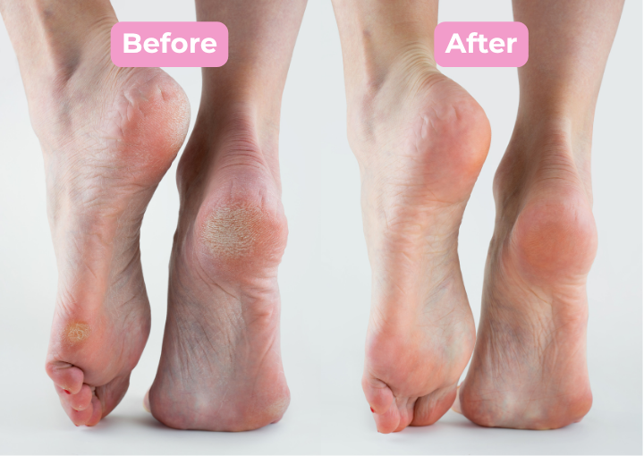 HeelFix Pro: Electric Dead Skin Remover For Feet